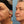 Load image into Gallery viewer, Dermal Filler Treatment in Whitby - MD Aesthetics