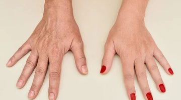 Don't let your hands give away your age - MD Aesthetics