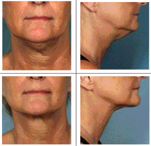 Do you have a double chin?