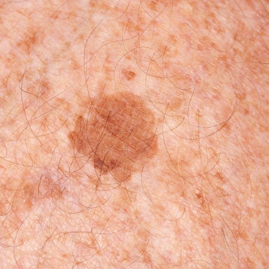 Age Spot (Solar Lentigines)