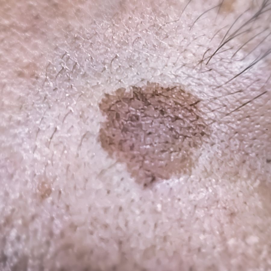 Sun Spot (Actinic Keratoses)