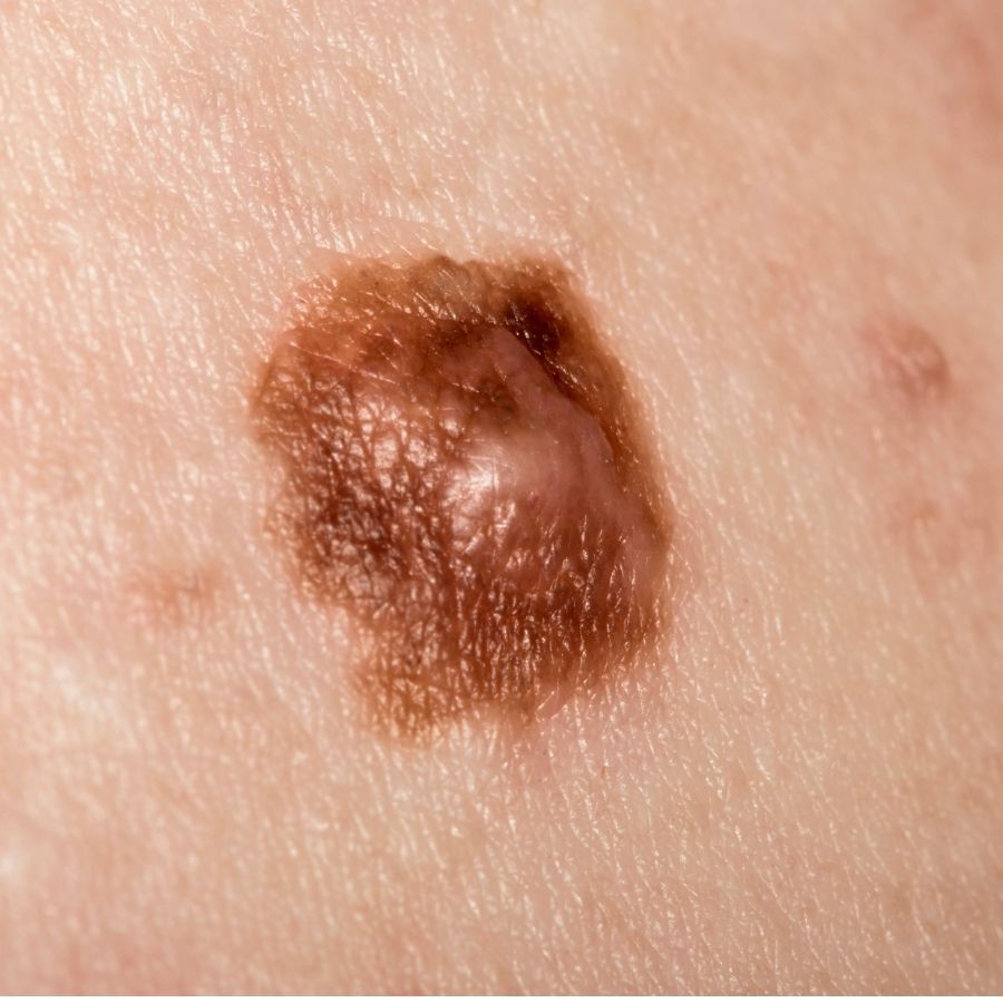 Melanoma