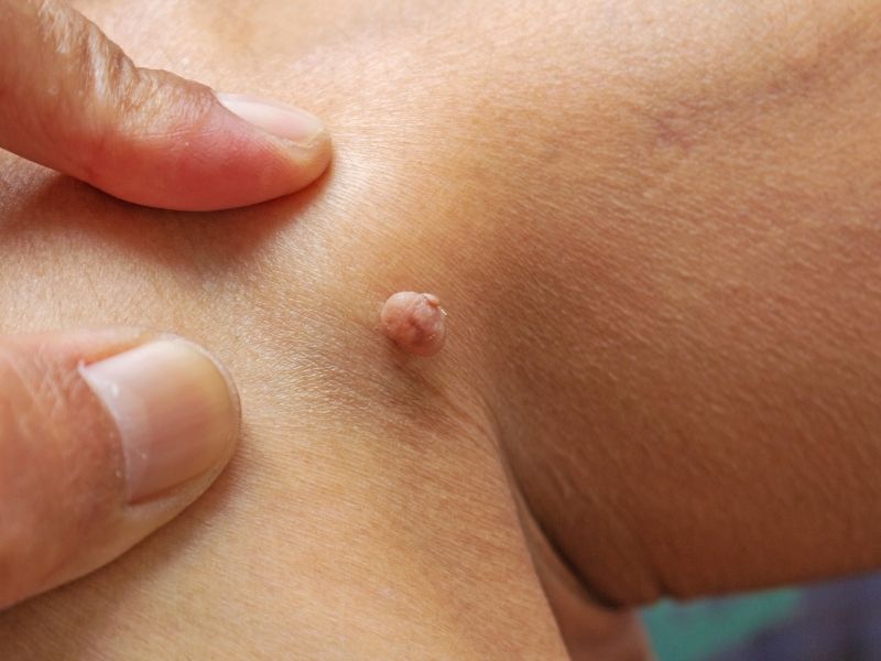 Skin Tag Assessment & Removal | Copeland MD Aesthetics