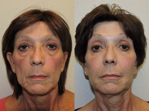 Dermal Filler Treatment in Whitby - MD Aesthetics
