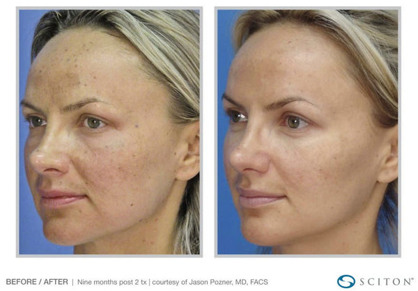 Nano and Micro Laser Peels - MD Aesthetics