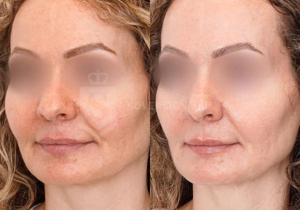 Vital II (Skin Boosting) Beauty Boost in Whitby - MD Aesthetics