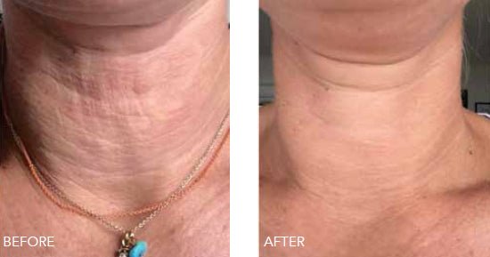 Vital II (Skin Boosting) Beauty Boost in Whitby - MD Aesthetics