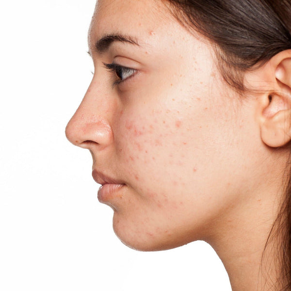 Acne Services - MD Aesthetics