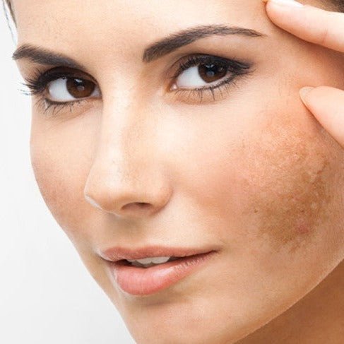 Pigment & Rosacea Products - MD Aesthetics