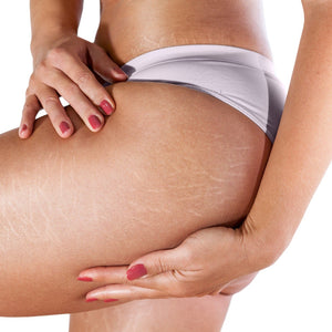 Stretch Marks - MD Aesthetics
